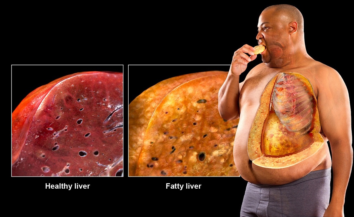کبد چرب از چیست