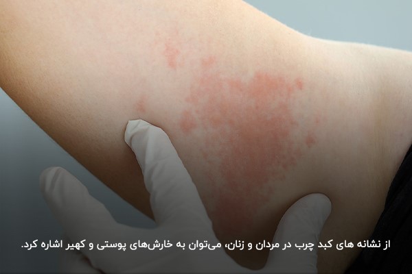 کبد چرب از چیست