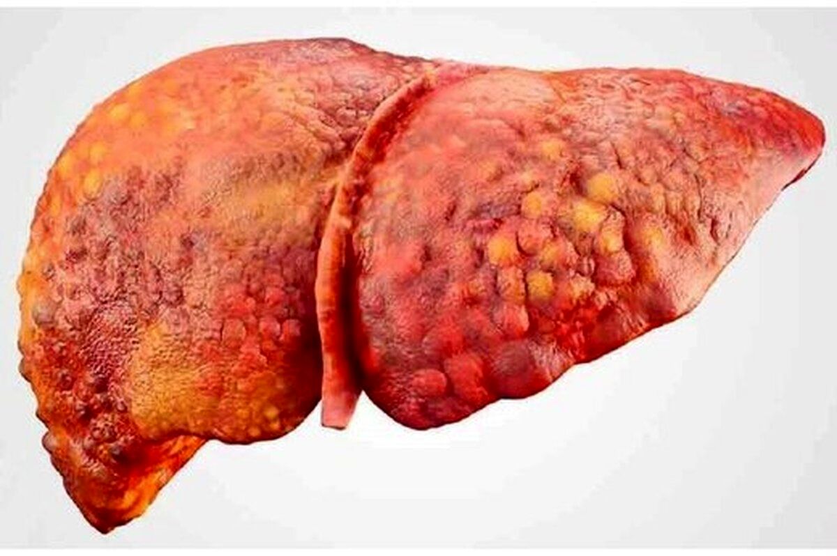 خرید قرص کبد چرب